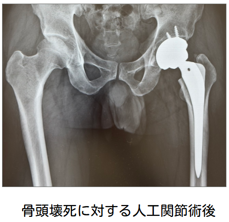 左人工股関節の術後レントゲン（当院から基幹病院にご紹介し手術となった方です）