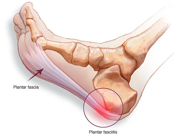 足底腱膜炎は足の裏の痛みが出る疾患で、特に歩き初めに強い痛みが出やすい