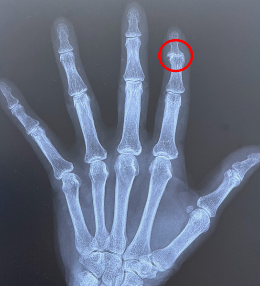 当院のレントゲン:関節の隙間が狭くなり、骨のとげができている(関節裂隙狭小化、骨棘形成)