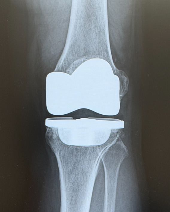 リウマチ性の膝関節変形に対する人工関節手術(当院のレントゲン、手術は提携病院にて)