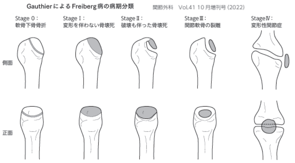 フライバーグ病（Freiberg病）におけるGauthier分類 
