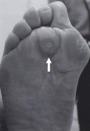 足裏のたこ(胼胝:べんち)