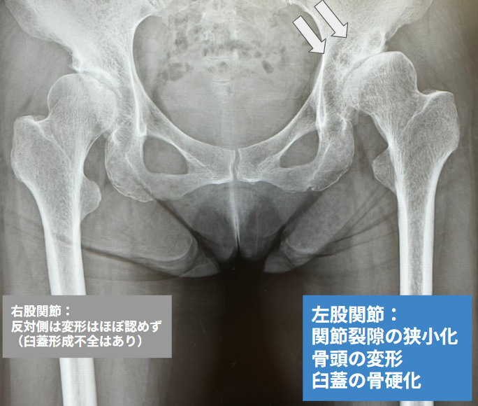 臼蓋形成不全由来の変形性股関節症関節症（当院で撮影）