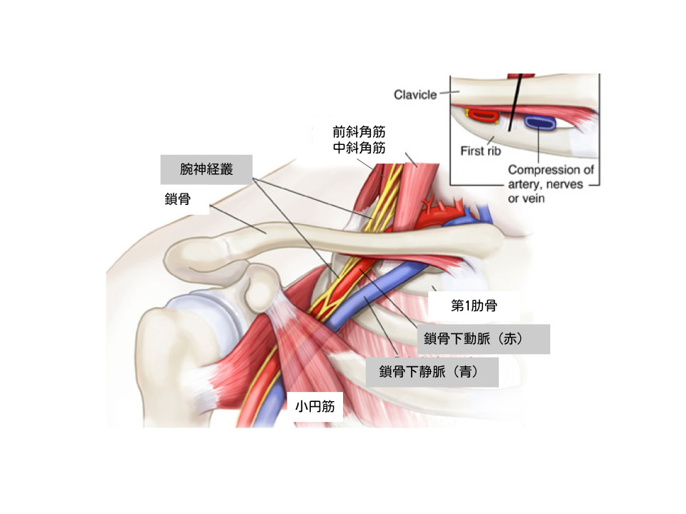 胸郭出口症候群は腕神経叢、鎖骨下動脈、鎖骨下静脈が斜角筋、鎖骨、肋骨、小円筋、頚肋などに圧迫を受けることにより発症すると考えられている