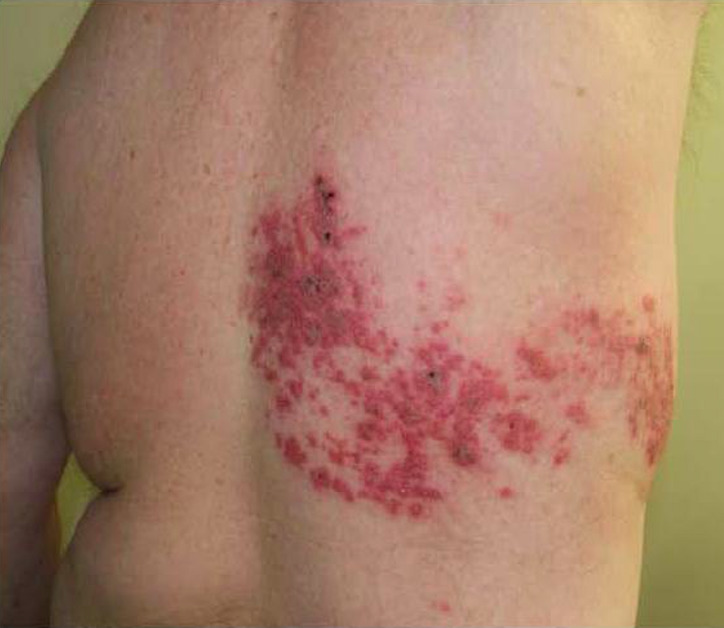 帯状疱疹は強い痛みを伴う水泡を生じる皮膚のヘルペスウイルス感染症です
