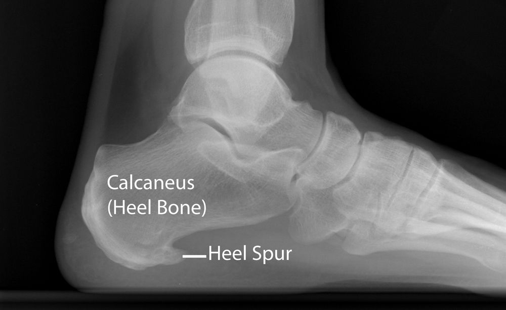 踵骨の骨棘 「Heel Spur」 は足底腱膜炎の原因ではなく結果であることが多く、骨棘を切除することがそのまま治療となるわけではない
