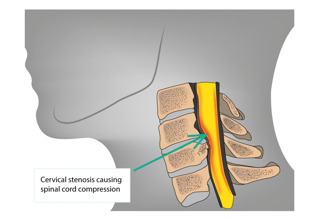 頚椎症性脊髄症は神経の通り道である脊柱管が狭くなって脊髄が圧迫されることにより起こる神経の病気です。