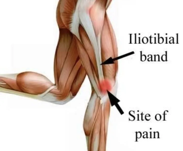 腸脛靭帯炎はランニングなどの運動により膝の外側に疼痛が出るスポーツ障害です
