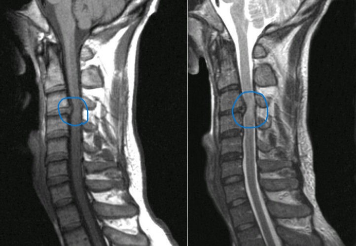 MRIでは突出した椎間板が確認できます