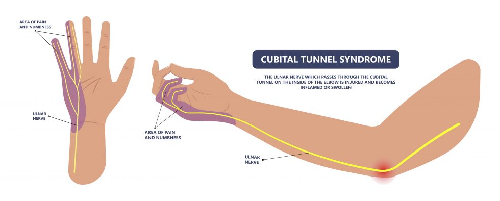 肘部管症候群では手の小指側のみがしびれます。薬指は外側半分のみがしびれるのが一般的ですが、そうならないこともあります。