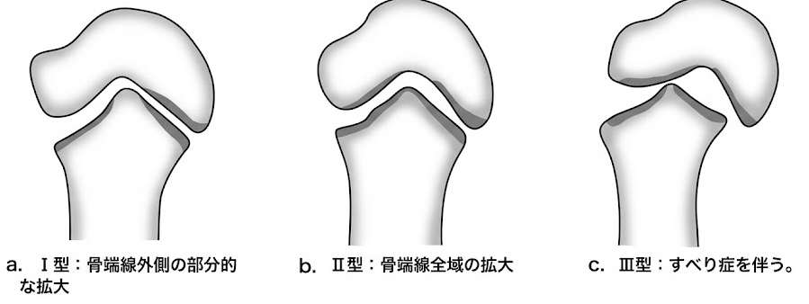 Ⅰ型(骨端線外側部の離開)・Ⅱ型(骨端線全体の離開)・Ⅲ型(骨端線全体の大きな離開)