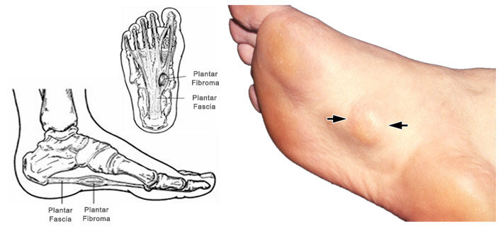 足底線維腫症は足の裏にできもの、しこりを生じる良性疾患です