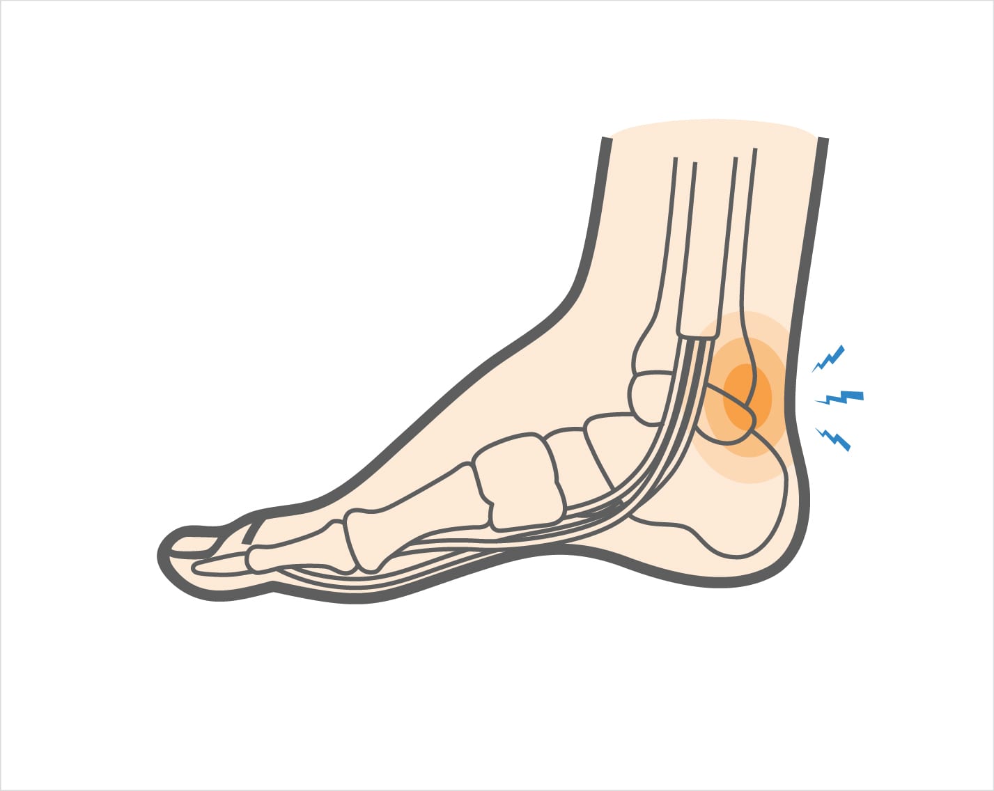 三角骨障害では足関節の後方に運動時の疼痛がみられます