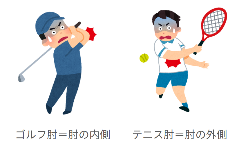 ゴルフ肘は肘の内側の痛み、テニス肘は肘の外側の痛み