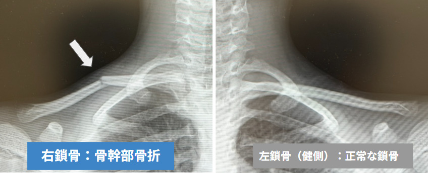 右鎖骨の骨幹部（中央部）骨折（当院で撮影したレントゲン）