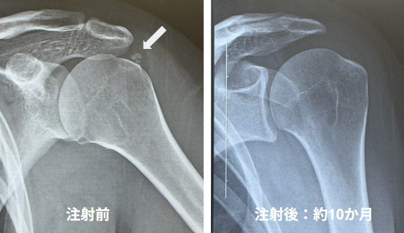 石灰沈着性腱板炎の当院の注射治療例｜注射で痛み改善・石灰吸収を確認