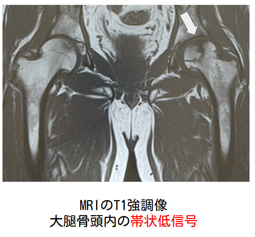 大腿骨頭壊死のMRI（提携医療機関で施行）