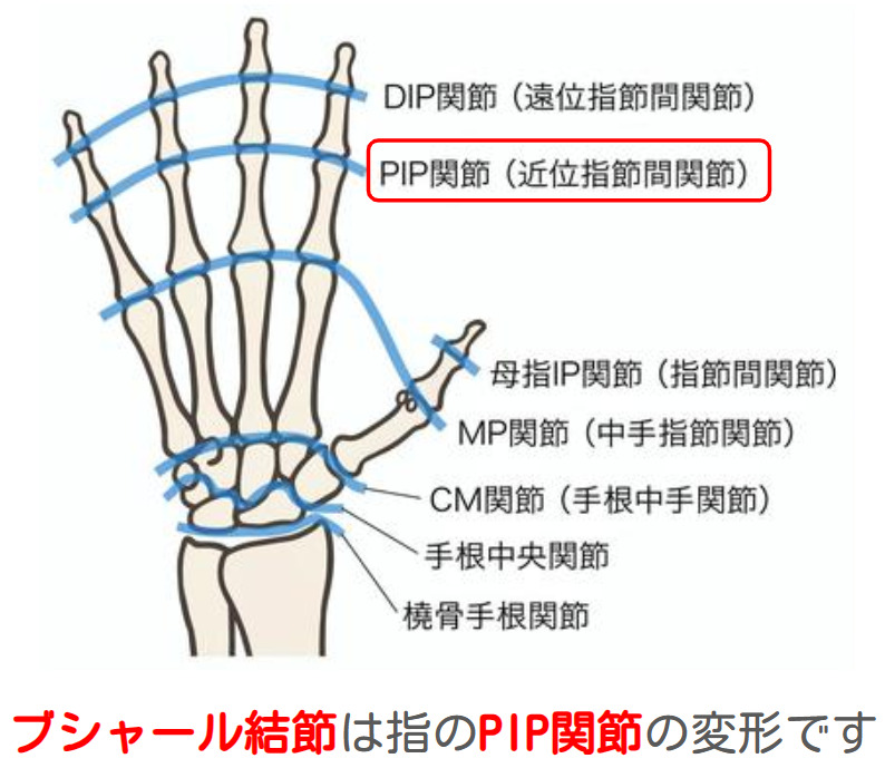 ブシャール結節は指のDIP関節の変形です