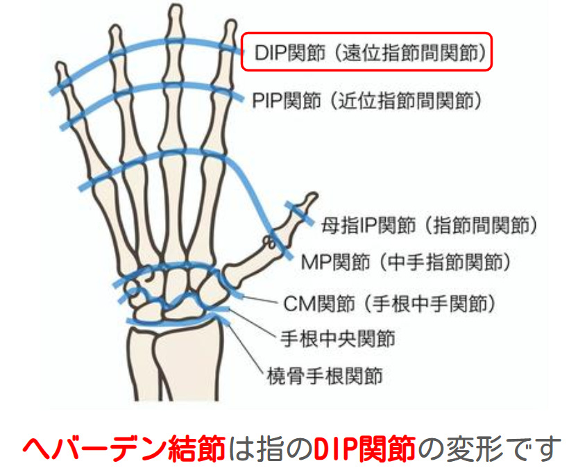 へバーデン結節は指のDIP関節の変形です