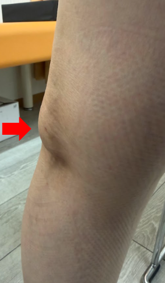 当院で撮影したベーカー嚢腫の実例です。膝裏のふくらみ・しこりをエコーで評価し、必要に応じてエコーガイド下穿刺まで対応しています(大阪市淀川区・三国駅1分)