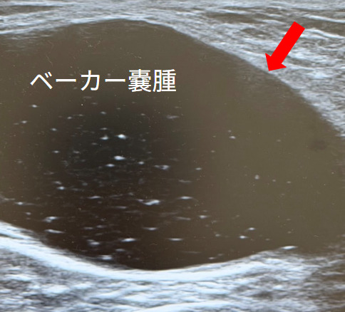 ベーカー嚢腫の当院でのエコー画像|膝裏のふくらみの実例(淀川区・三国駅1分)