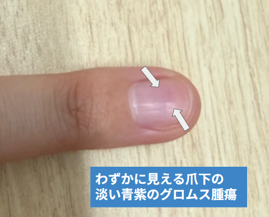 爪下に透けて見える淡い青紫色のグロムス腫瘍(当院で撮影)