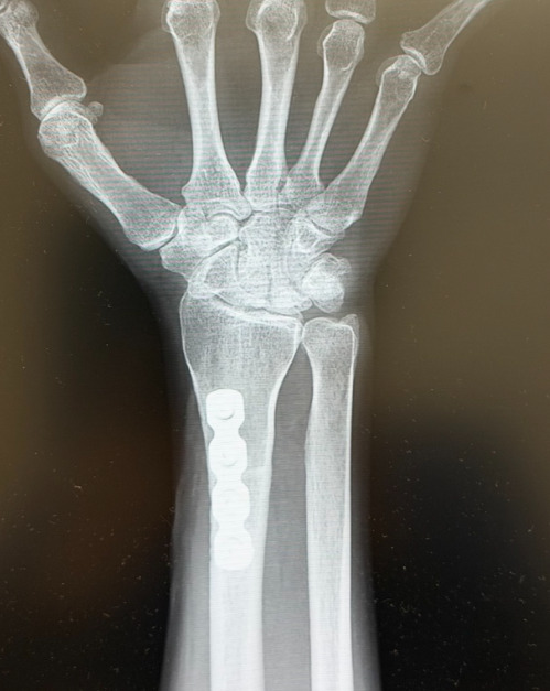キーンベック病に対する橈骨短縮骨切り術（当院で施行したレントゲン）