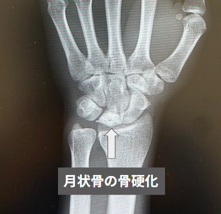 キーンベック病でみられる月状骨の骨硬化（当院で施行した手部レントゲン）