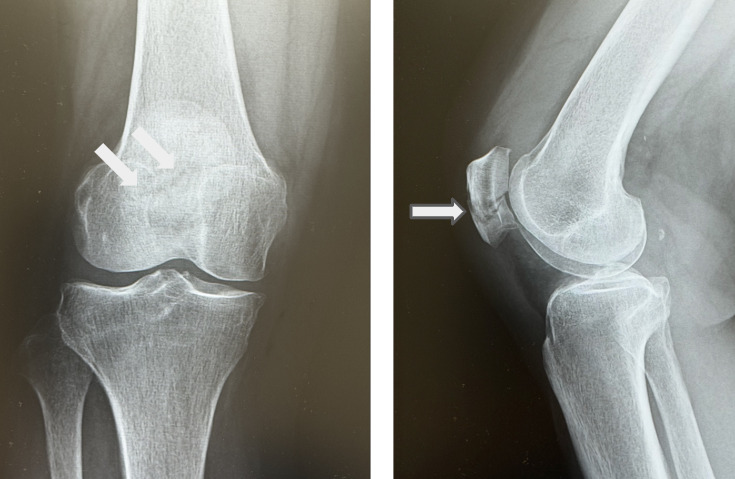 当院でのレントゲン：膝蓋骨の横骨折