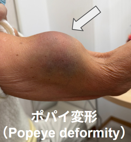上腕二頭筋長頭腱に特徴的なポパイ変形