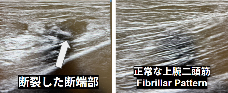 左）断裂した上腕二頭筋腱の断端部がエコーで確認できる　右）正常な上腕二頭筋（当院にて施行）