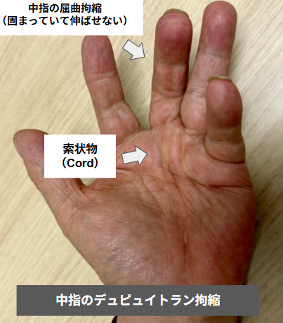 中指のデュピュイトラン拘縮(当院で撮影)