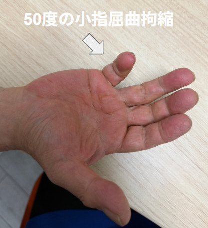 デュピュイトラン拘縮により小指に約50度の屈曲拘縮があります（当院で撮影）