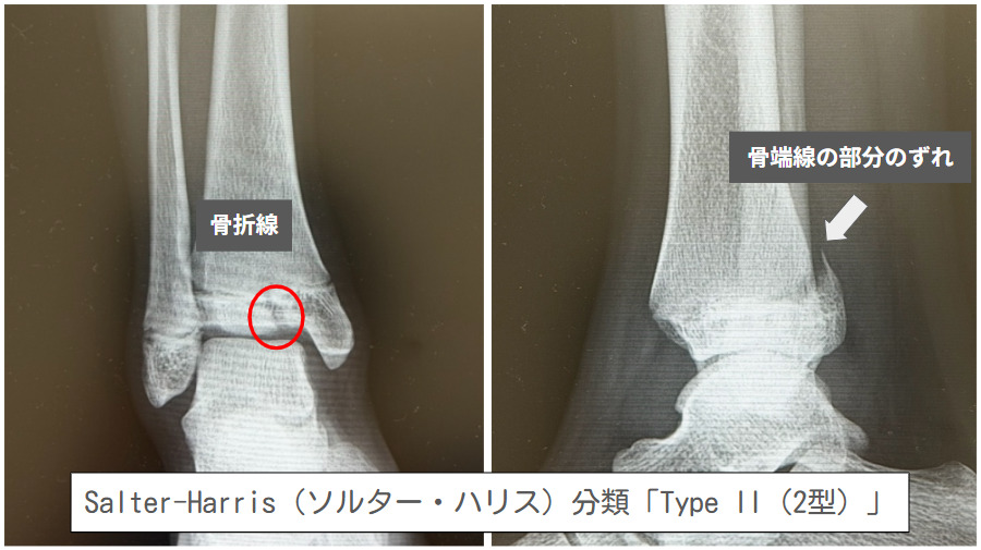 脛骨遠位骨端線離開（Type：Ⅱ）：当院で施行したレントゲンです