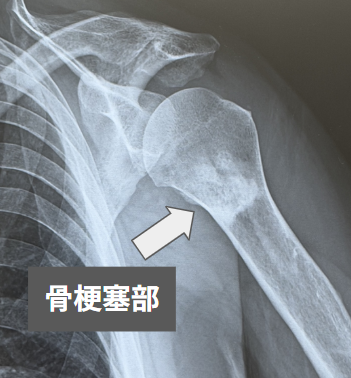 上腕骨の骨梗塞(骨硬化像で白く見える):当院でのレントゲン